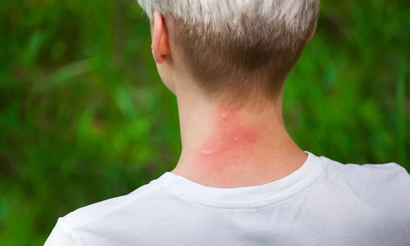 Κουνούπια: Πώς να τα κρατήσετε μακριά τρώγοντας σωστά!